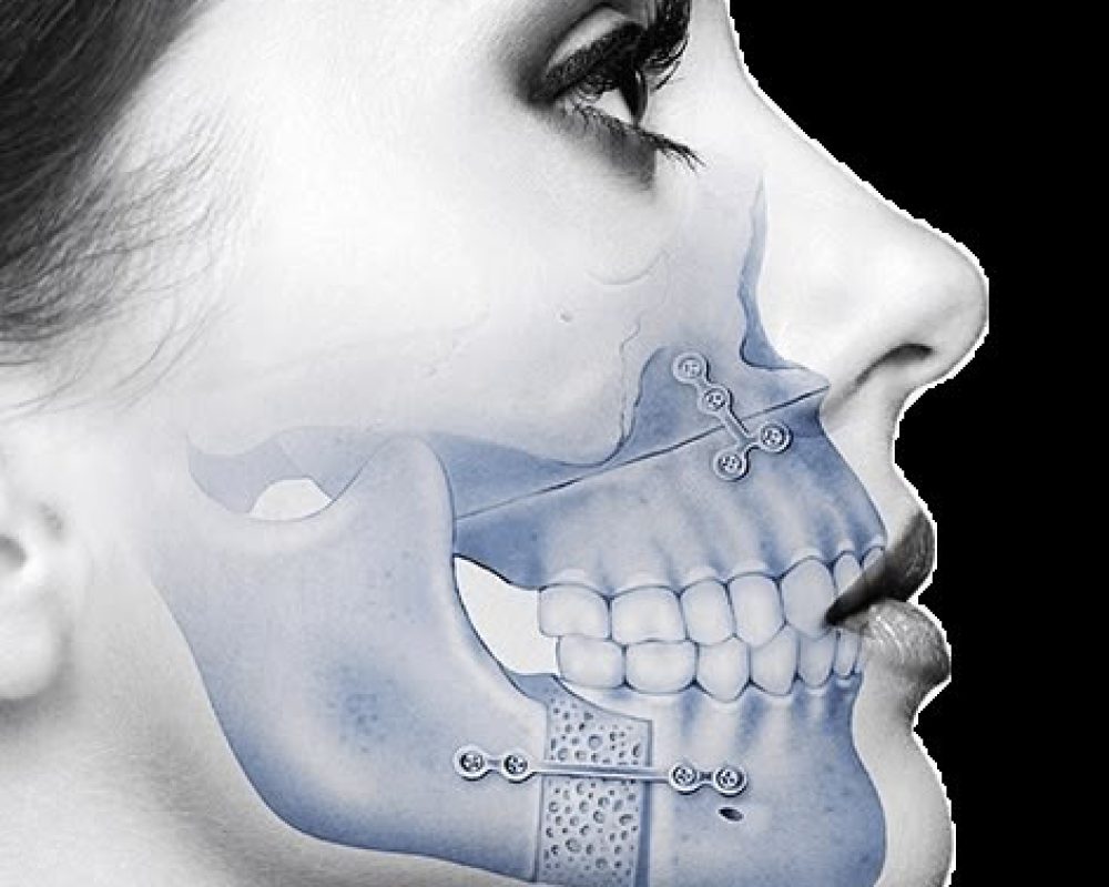10 tips to regain expressiveness after orthognathic surgery - Instituto Maxilofacial(1)